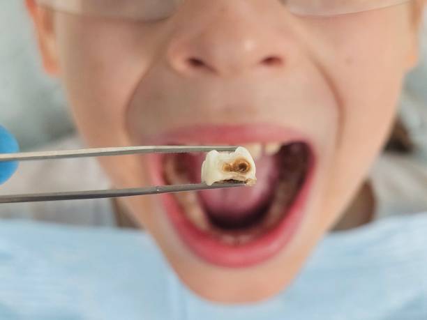 Best Emergency Treatment for Oral Infections in Maricopa, CA